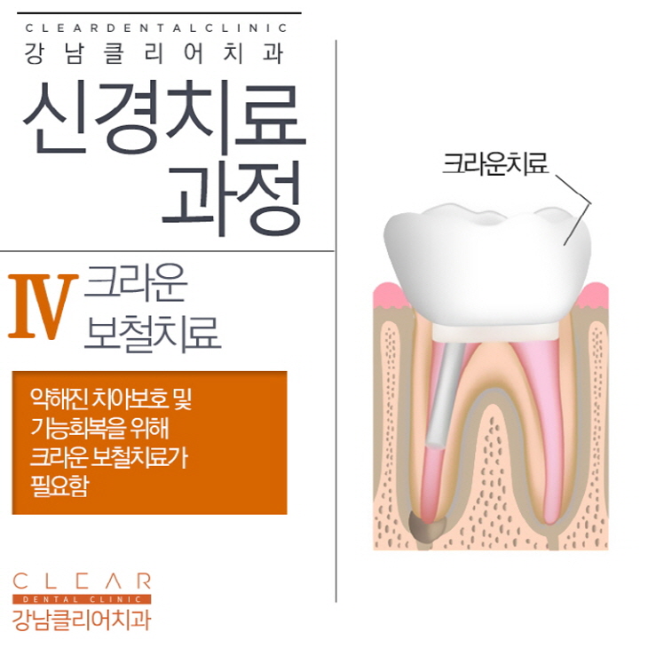 치아 신경치료 과정 순서 통증 등 신경치료의 모든것 관련 이미지 7