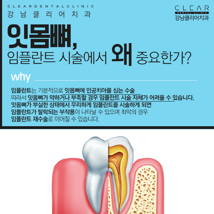 뼈이식임플란트 무엇이며 뼈이식은 왜 중요할까? 관련 이미지 4