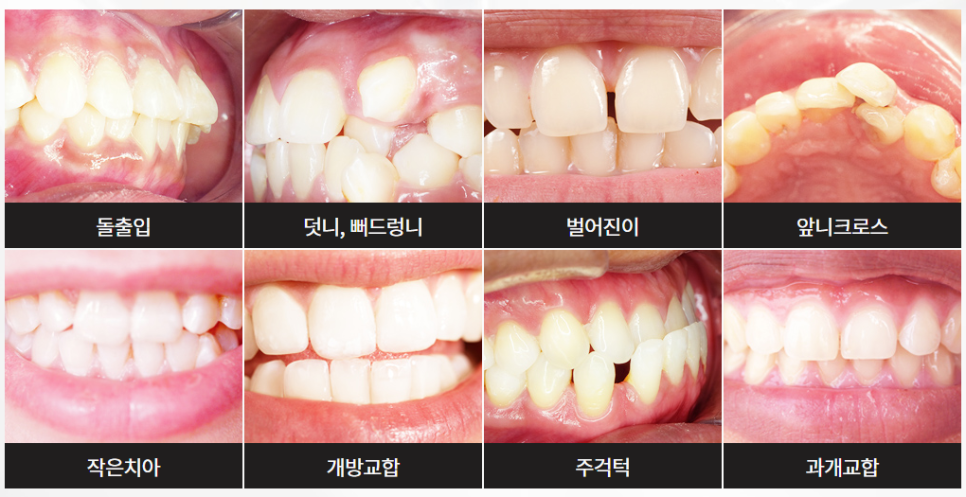 역삼동 부정교합 어떤 치료를 해야 할까? 관련 이미지 2