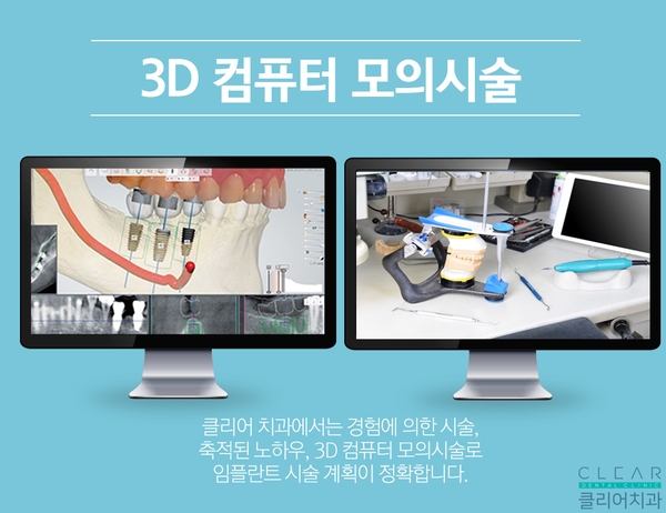 내 생에 첫 임플란트 관련 이미지 3