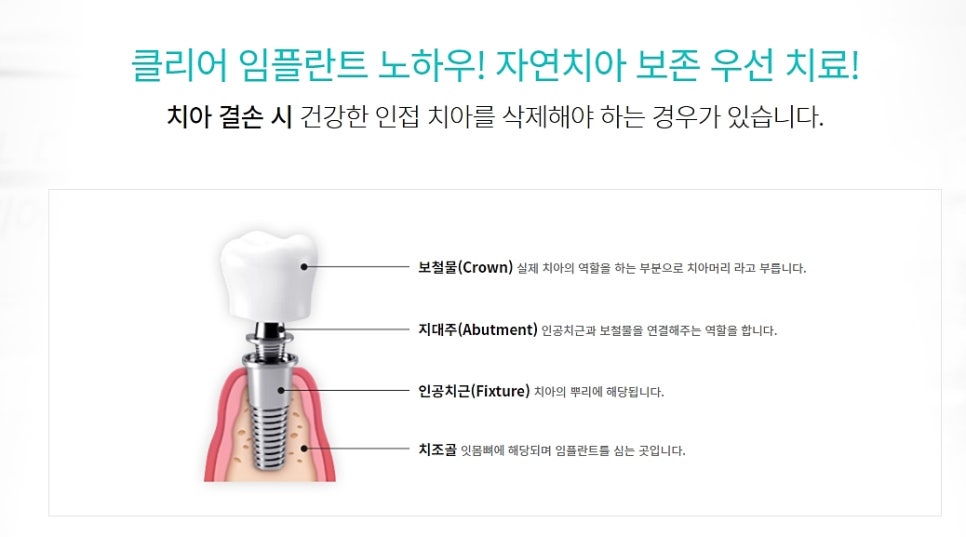 강남클리어치과 임플란트 찾고 결정 관련 이미지 4