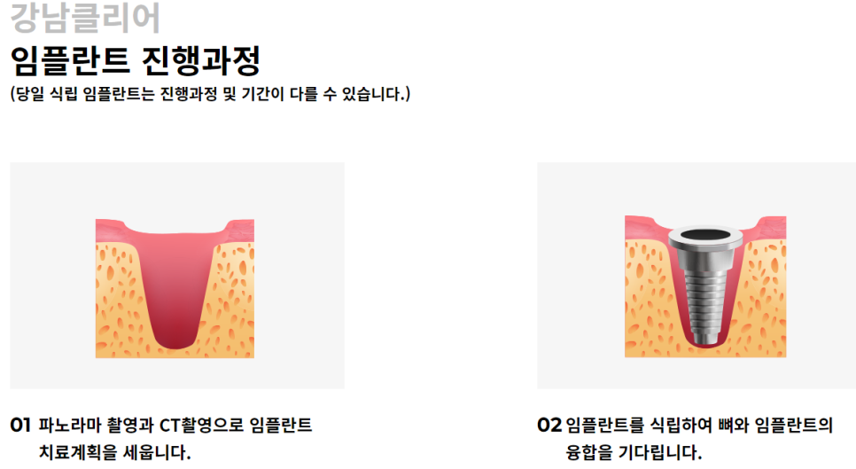 논현동임플란트치과 오래 사용할 수 있도록 관련 이미지 5