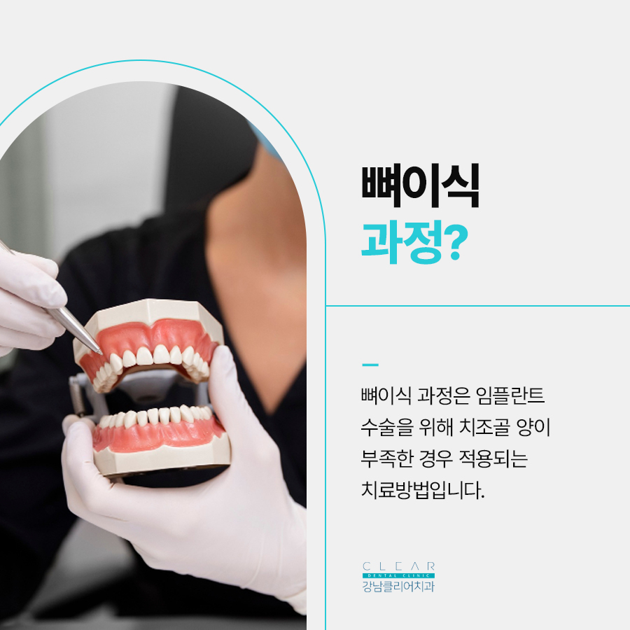 역삼역 임플란트 치과 뼈이식으로 튼튼한 식립을 관련 이미지 2