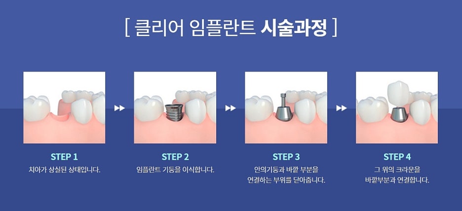 강남역 임플란트치과 관심 있게 찾아보고 관련 이미지 5