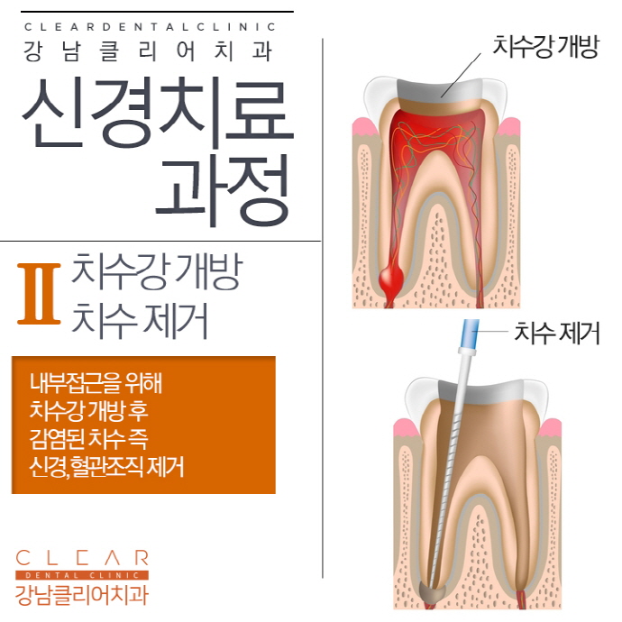 치과신경치료, 신경치료 후 크라운 꼭 해야하는걸까? 관련 이미지 6