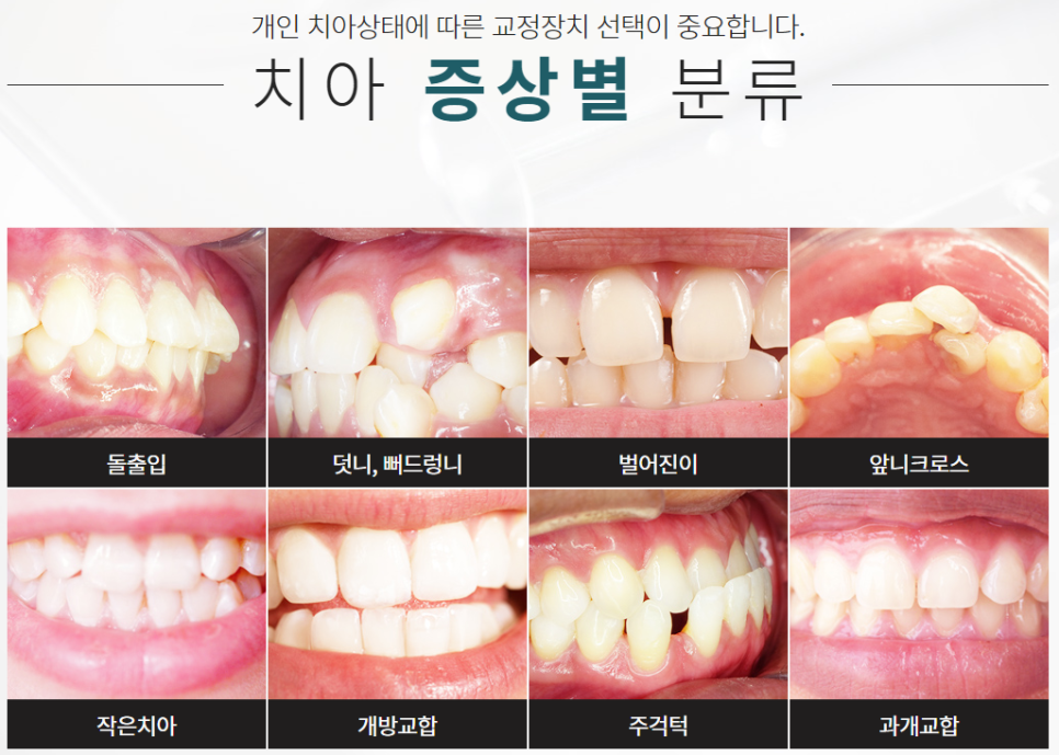 서초동치아교정잘하는곳 심미성까지 생각한다면 관련 이미지 2