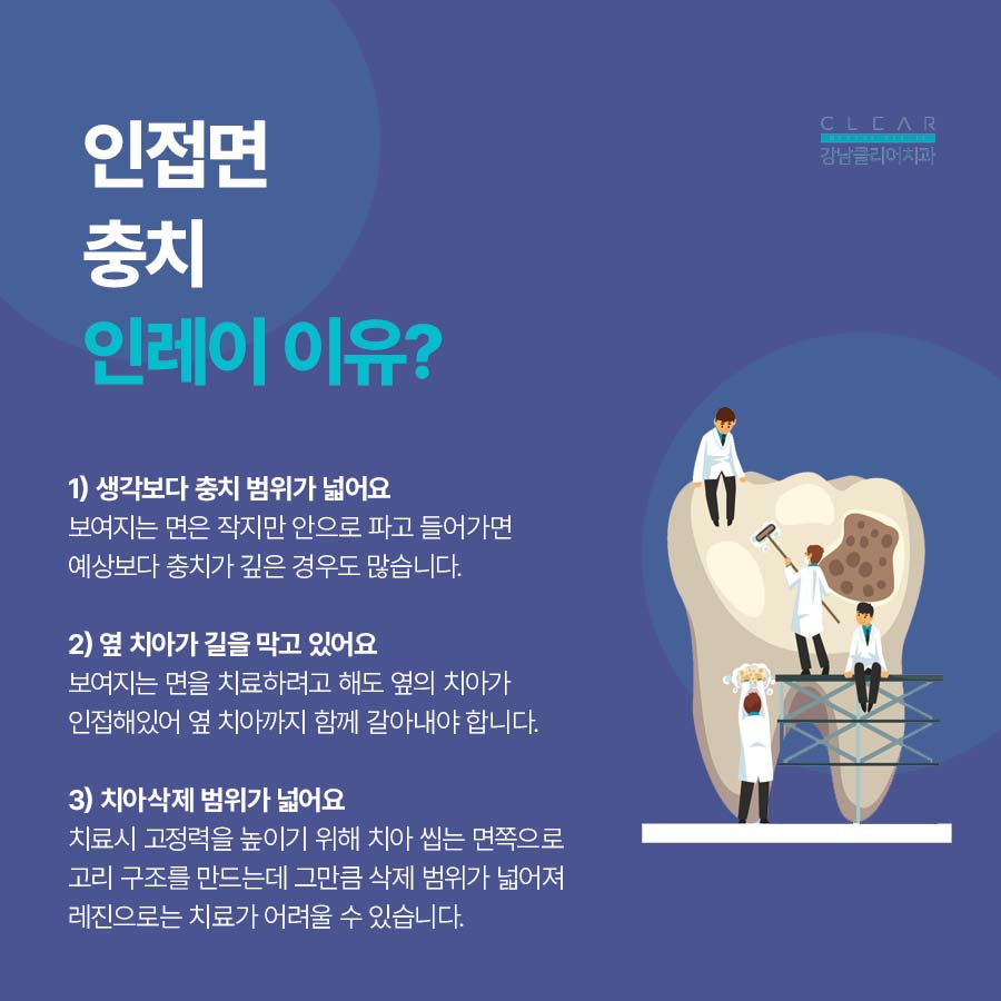어금니 인접면충치 인레이 치료 적합한 이유 관련 이미지 3