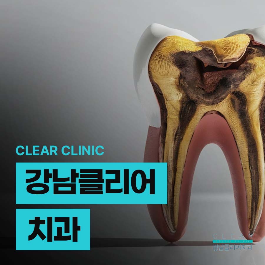 강남클리어치과 충치치료 후 통증 이유 정리 관련 이미지 1