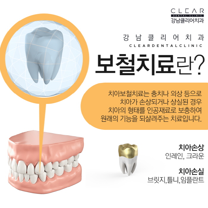 치아 보철치료 종류 심미보철 등 다양해 관련 이미지 2