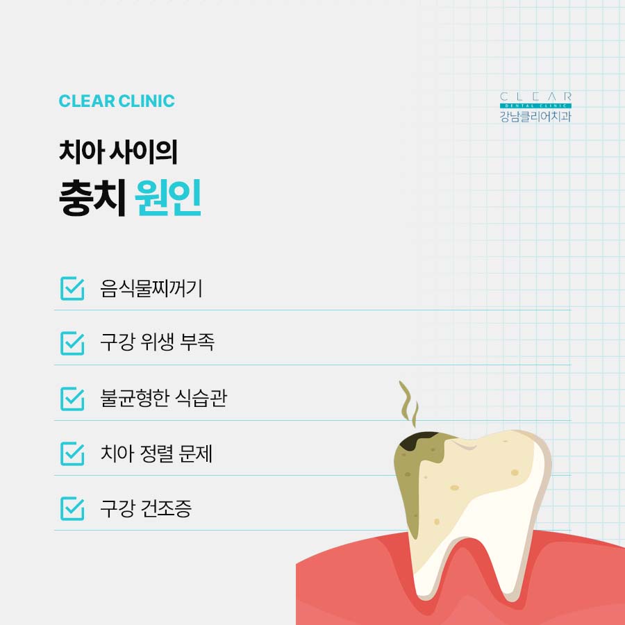 치아 사이 충치 보이지 않으니까 더 주의해야 관련 이미지 3