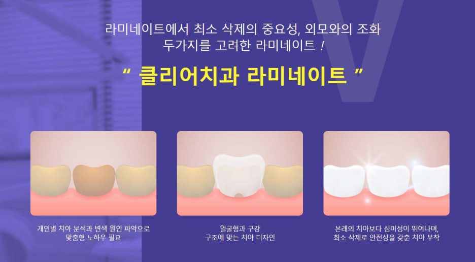 논현동 라미네이트 주의사항 꼭 알아야해요 관련 이미지 7