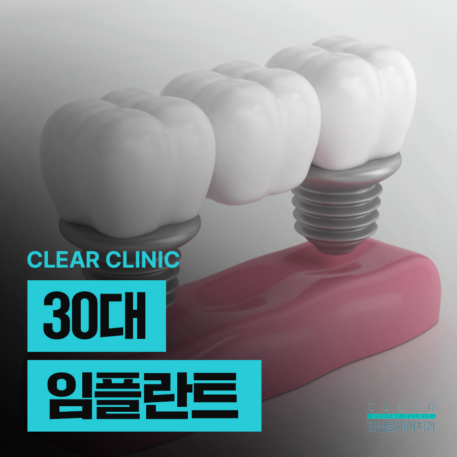 30대임플란트 차이점 및 주의사항 관련 이미지 1