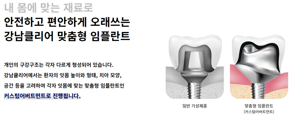 강남역임플란트치과 신중하게 선택해야 관련 이미지 6