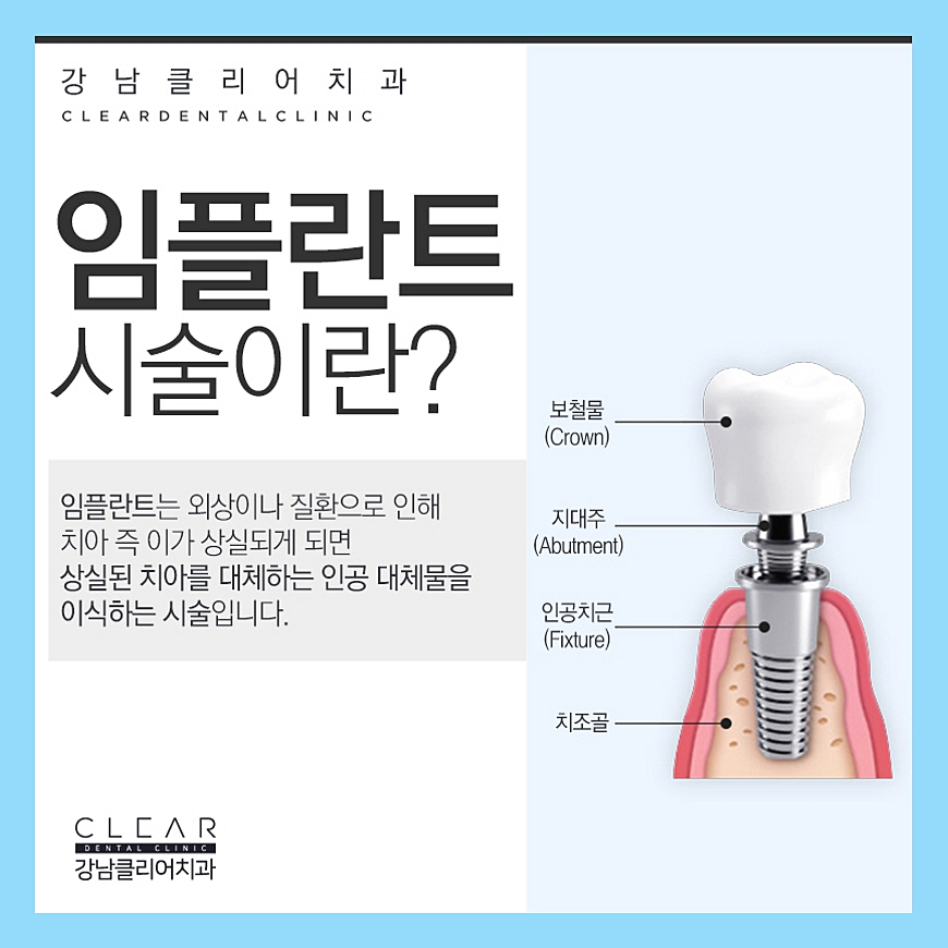 강남역 임플란트 원데이 알아보기 관련 이미지 2