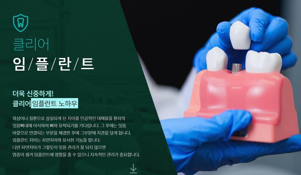 임플란트의 종류 남다른 방법 관련 이미지 3