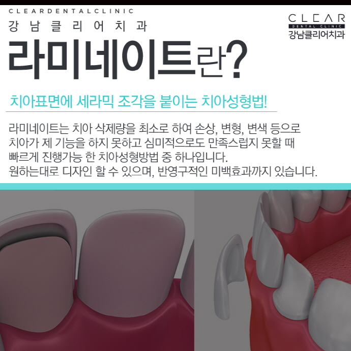강남역라미네이트 잘하는곳 맞춤 제작 나노V컷 라미네이트 관련 이미지 2