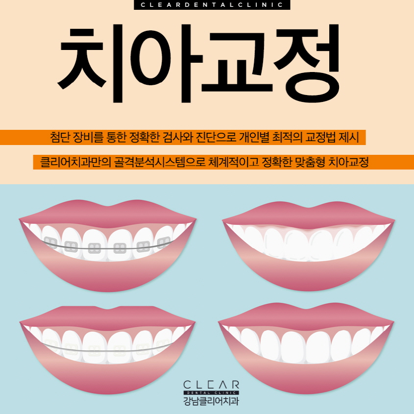 강남역치아교정치과 나에게 맞는 장치 선택이 중요 관련 이미지 1