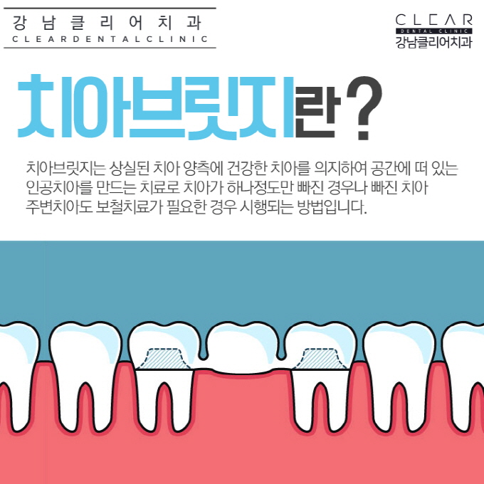 치아브릿지 강남치아브릿지도 이제 맞춤형으로 관련 이미지 2