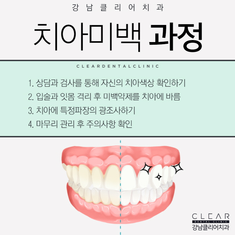 강남역 치과 치아미백 어떻게 다른걸까? 관련 이미지 4