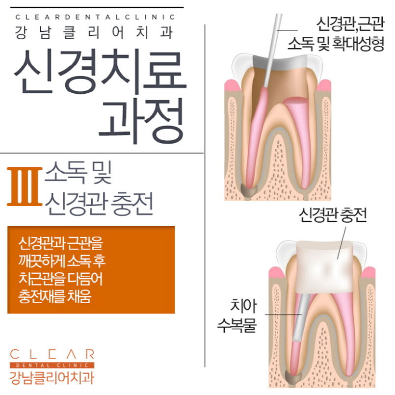 강남신경치료 늦어지면 안돼는 중요한 치료 관련 이미지 6