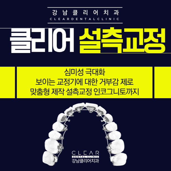 치아설측교정 인코그니토 교정으로 맞춤형 제작 교정도 가능 관련 이미지 1