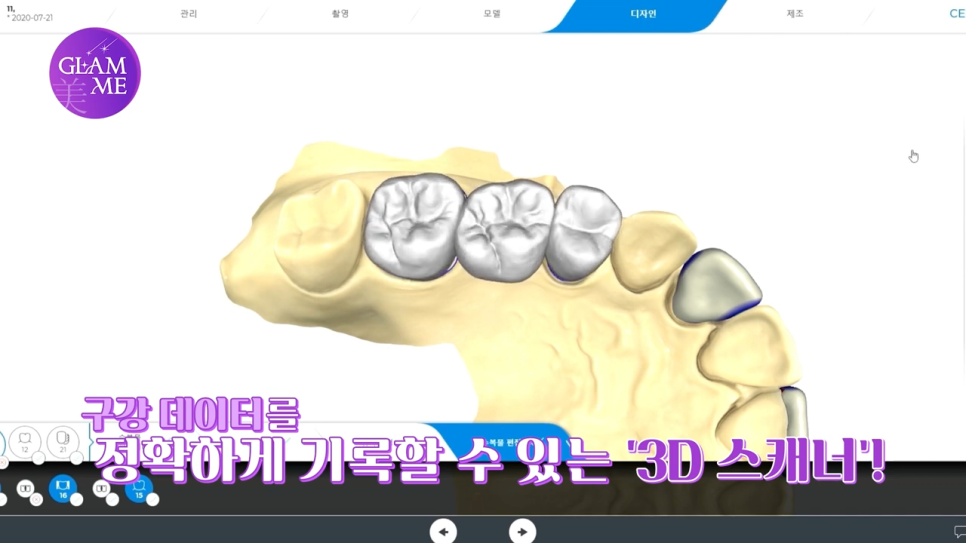 강남역임플란트치과 자연치에 가깝게 관련 이미지 11