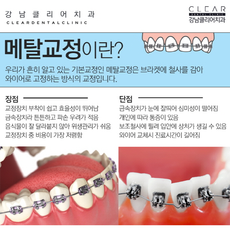 강남역치아교정치과 가지런한 치아 만드는 교정방법들 관련 이미지 2