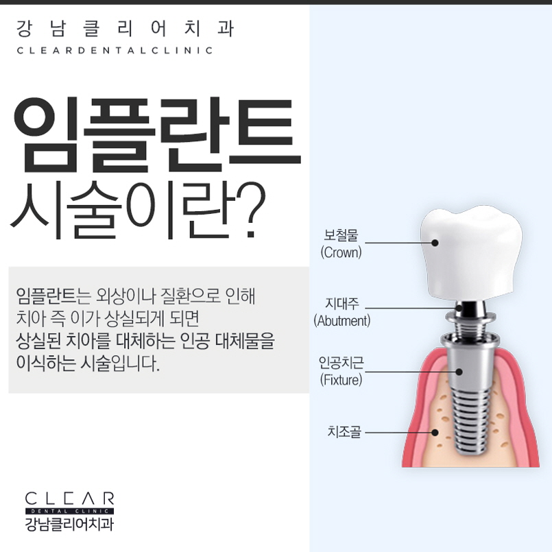 강남역임플란트 가격 무엇때문에 달라지게 될까? 관련 이미지 2