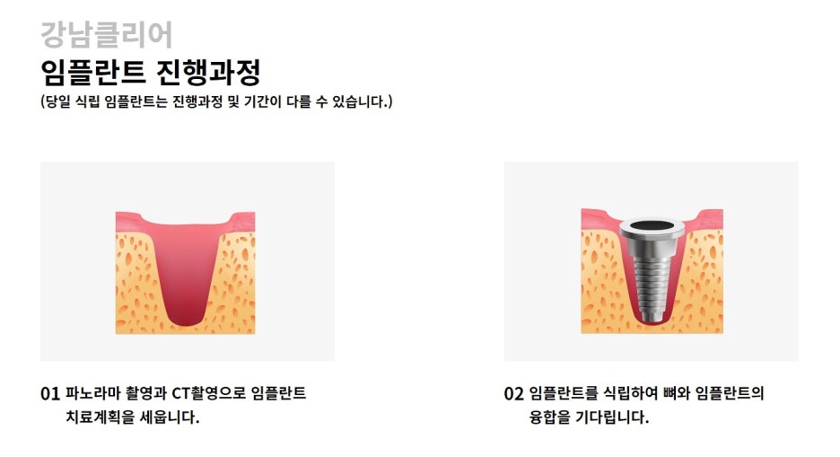 강남역 임플란트 잘하는곳 판단하고 결정해야 관련 이미지 5