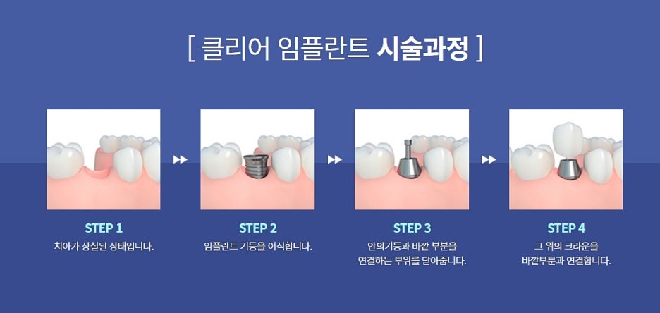 오스템임플란트 클리어치과 만족하려면 관련 이미지 6