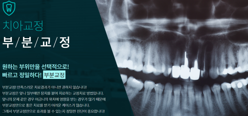 앞니 부분교정 비용 불편함이 적은 클리피씨 관련 이미지 8