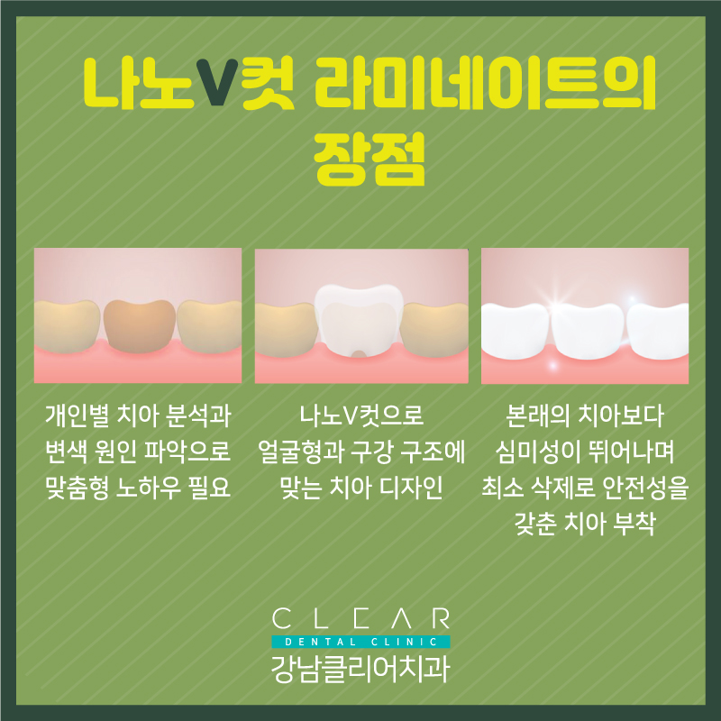 강남라미네이트 자연스러운 아름다움! 나노v컷 라미네이트 관련 이미지 4