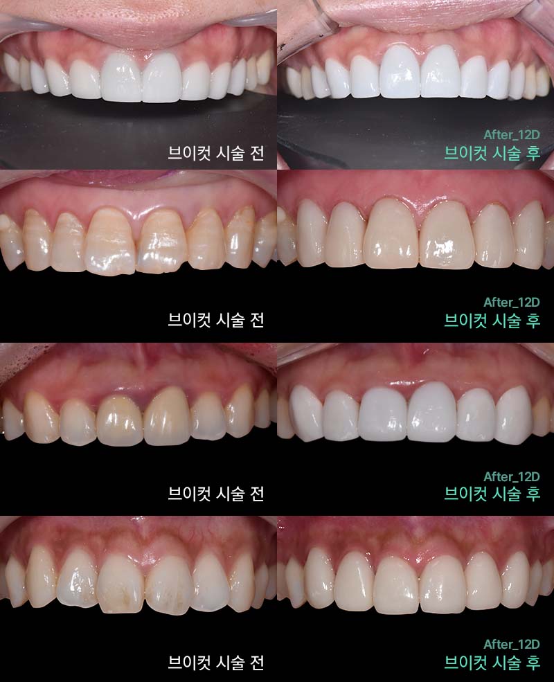 강남클리어치과 라미네이트 적절한 치아삭제가 관건 관련 이미지 5