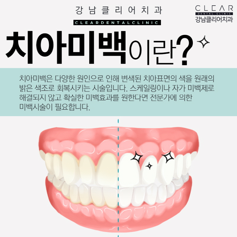 원데이 치아미백 금액 비용과 효과 알아보기 관련 이미지 2