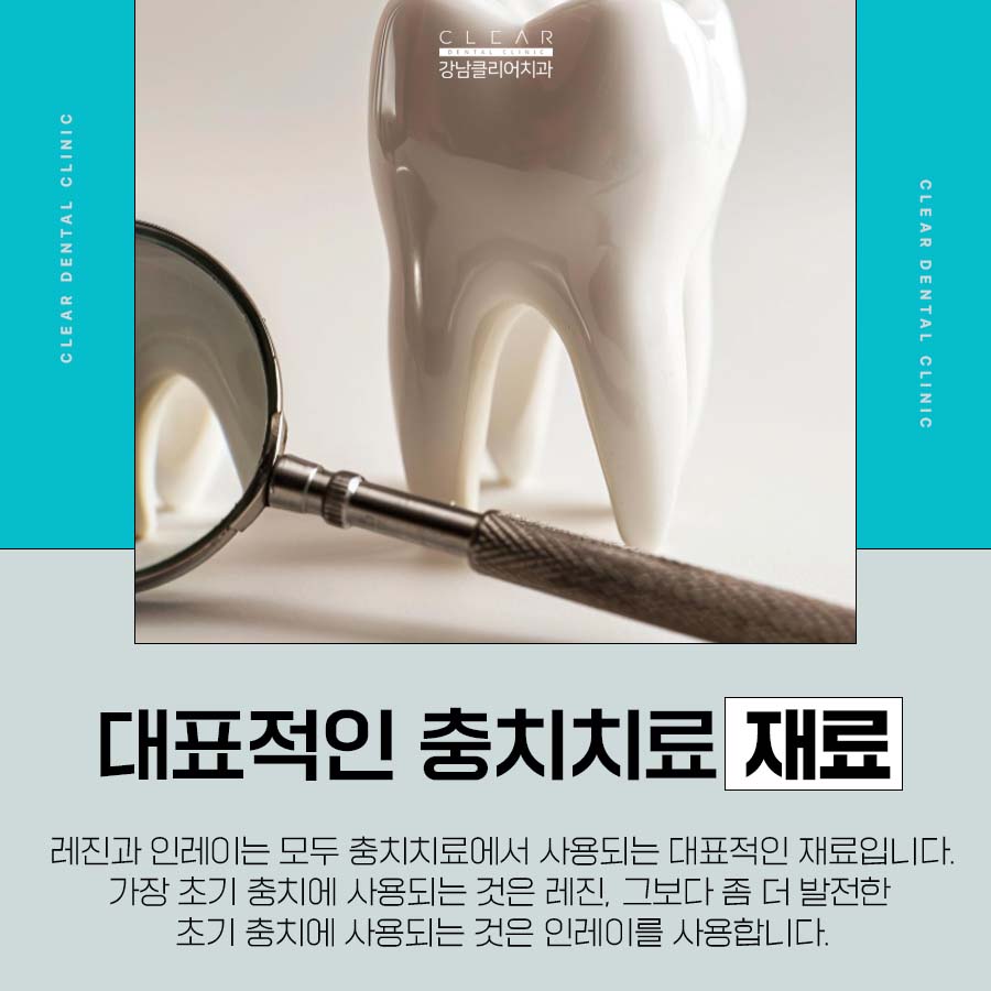 레진 인레이 차이 장단점 비교해보자 관련 이미지 2
