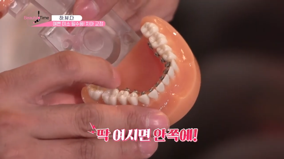 치아교정꿀팁 치아를 반듯하게 강남치과에서! 관련 이미지 6