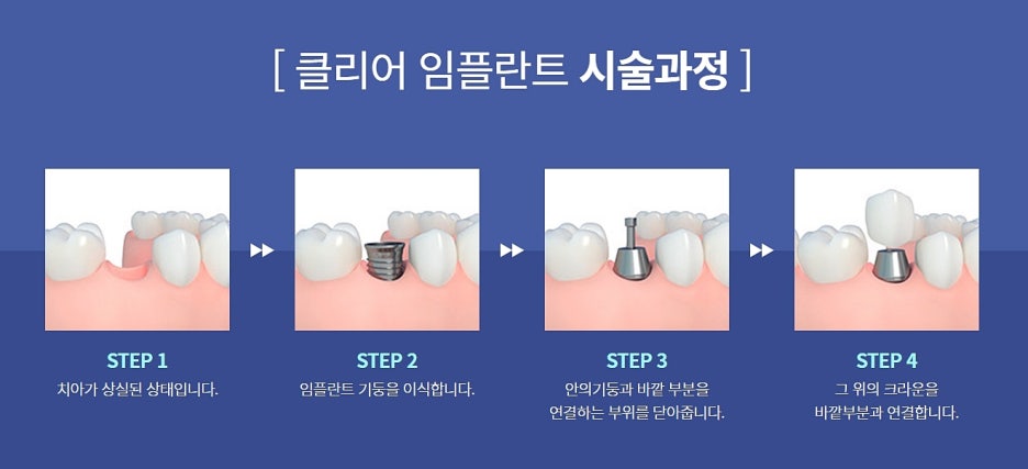 임플란트 실비보험 되는지 모르겠다면? 관련 이미지 3