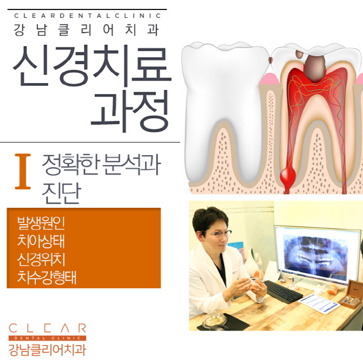 치아 신경치료 과정 순서 통증 등 신경치료의 모든것 관련 이미지 4