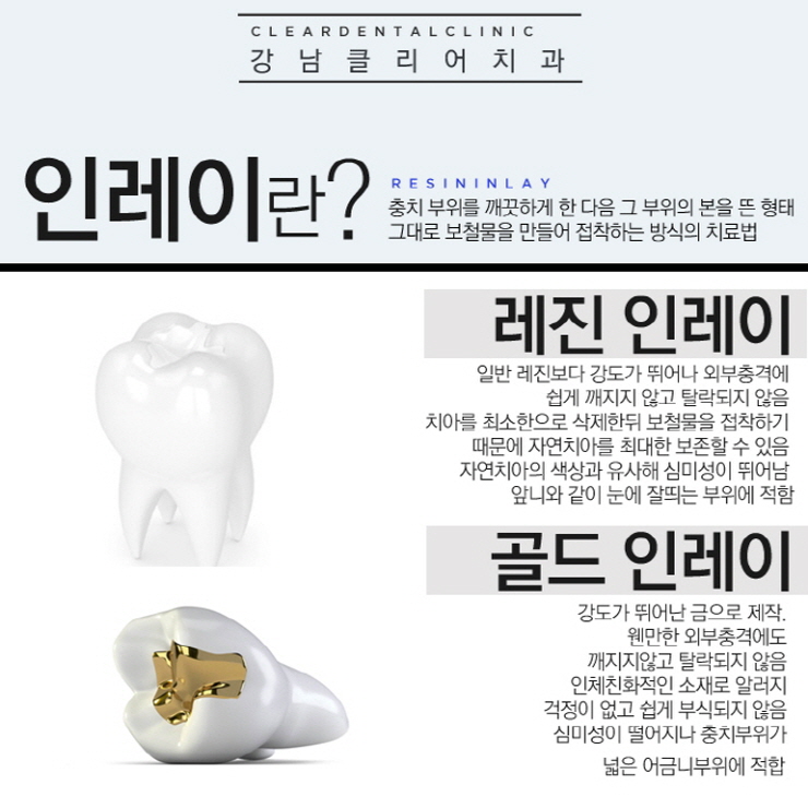 충치치료방법 단계별 필요한 보철치료까지 관련 이미지 7