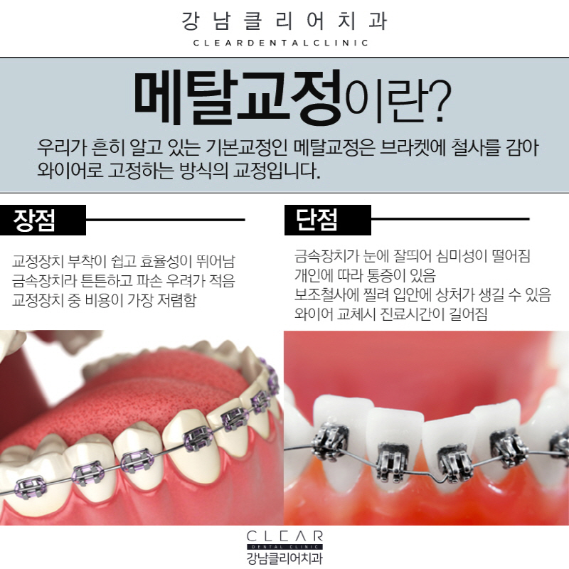 강남역클리피씨교정 결과, 심미성, 기간단축 모두 가능 관련 이미지 2