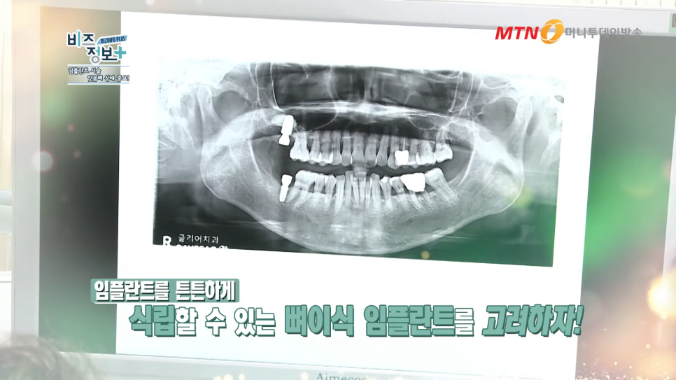 임플란트 주의사항 잇몸뼈의 상태도 봐야 관련 이미지 4
