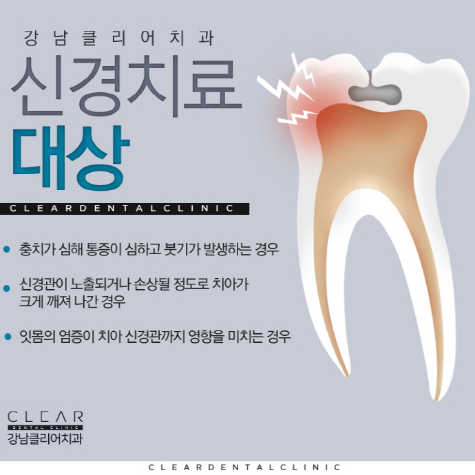 치아 신경치료 하는이유 자연치아 살리기 관련 이미지 3