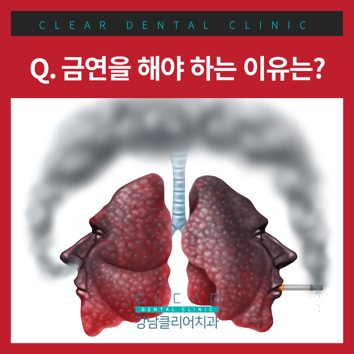 구강의 건강과 흡연 관련 이미지 2