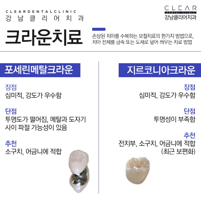 치아보철치료 치아보철종류 융시크 체험기 관련 이미지 7