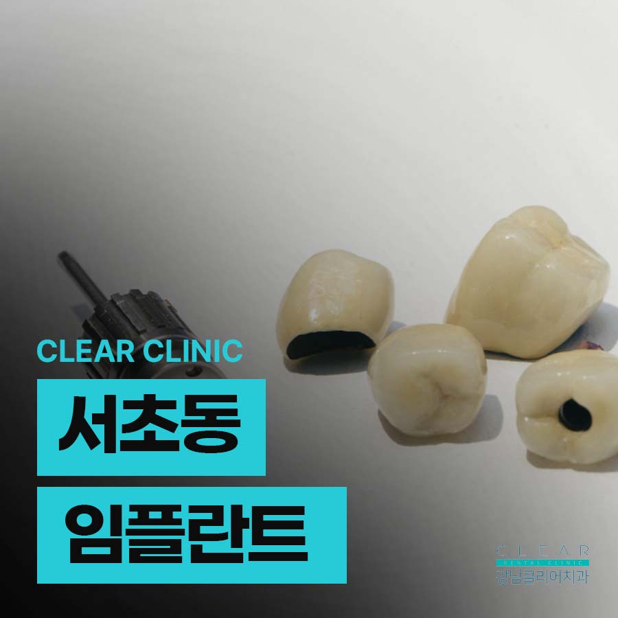 서초동 임플란트 앞니 식립 하려면 관련 이미지 1