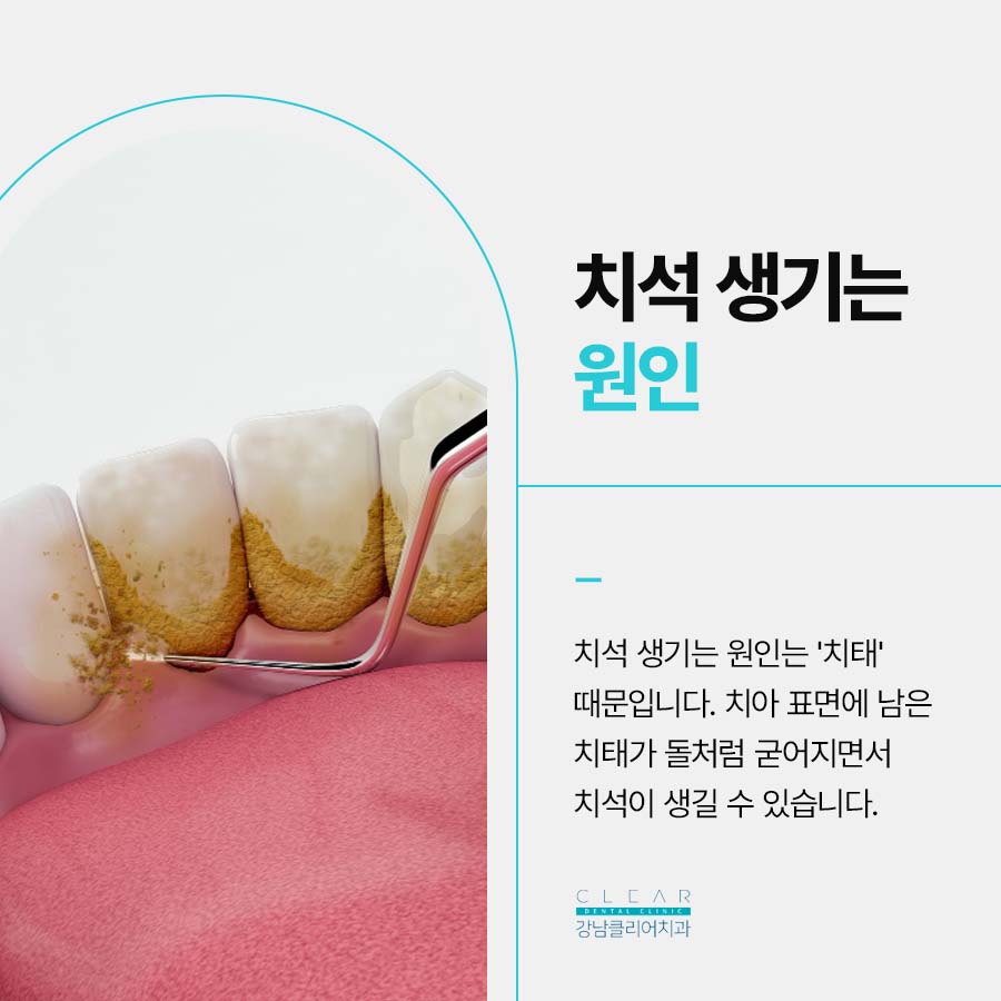역삼동 치과 치석 생기는 원인 제거방법은? 관련 이미지 2