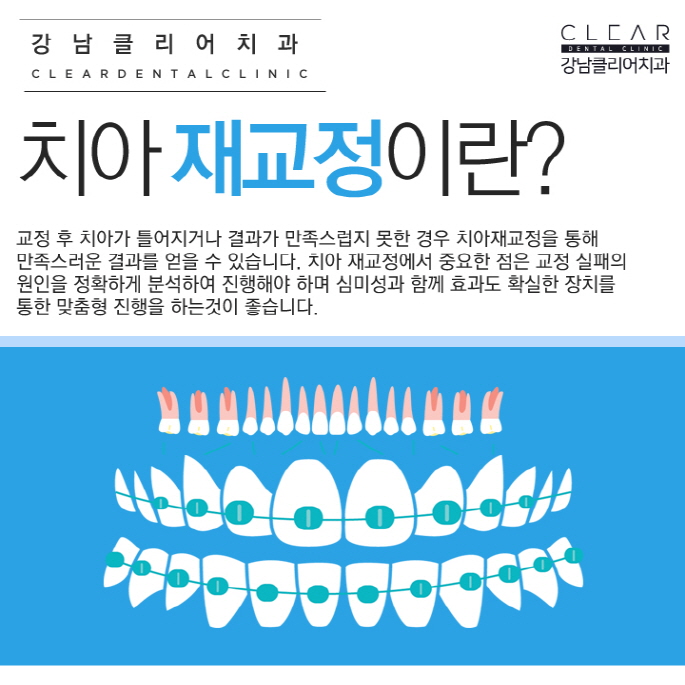 강남치아교정잘하는치과 치아교정종류 특징 관련 이미지 9