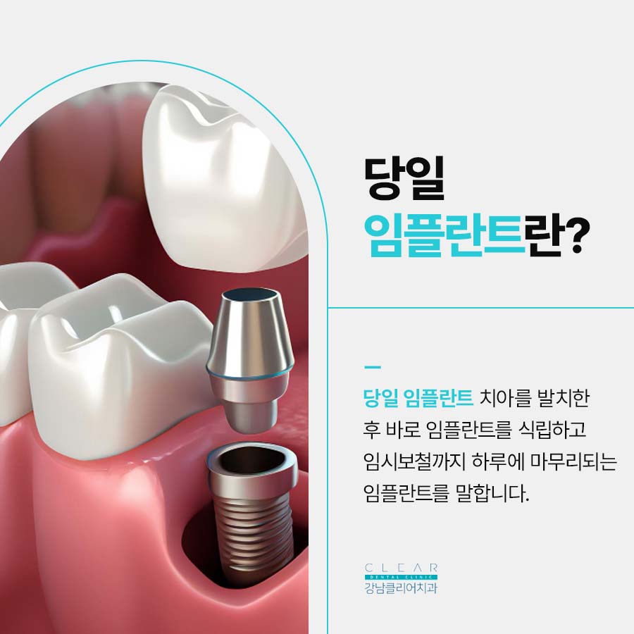서초동 임플란트 당일 가능한 조건은 관련 이미지 2