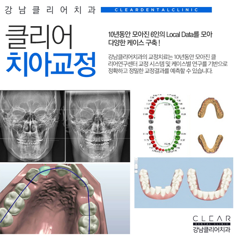 강남역투명교정 무엇을 중점으로 봐야할까요? 관련 이미지 6