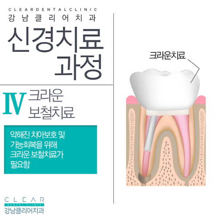 치아 신경치료 가볍고 쉽게 생각해선 안된다 관련 이미지 7